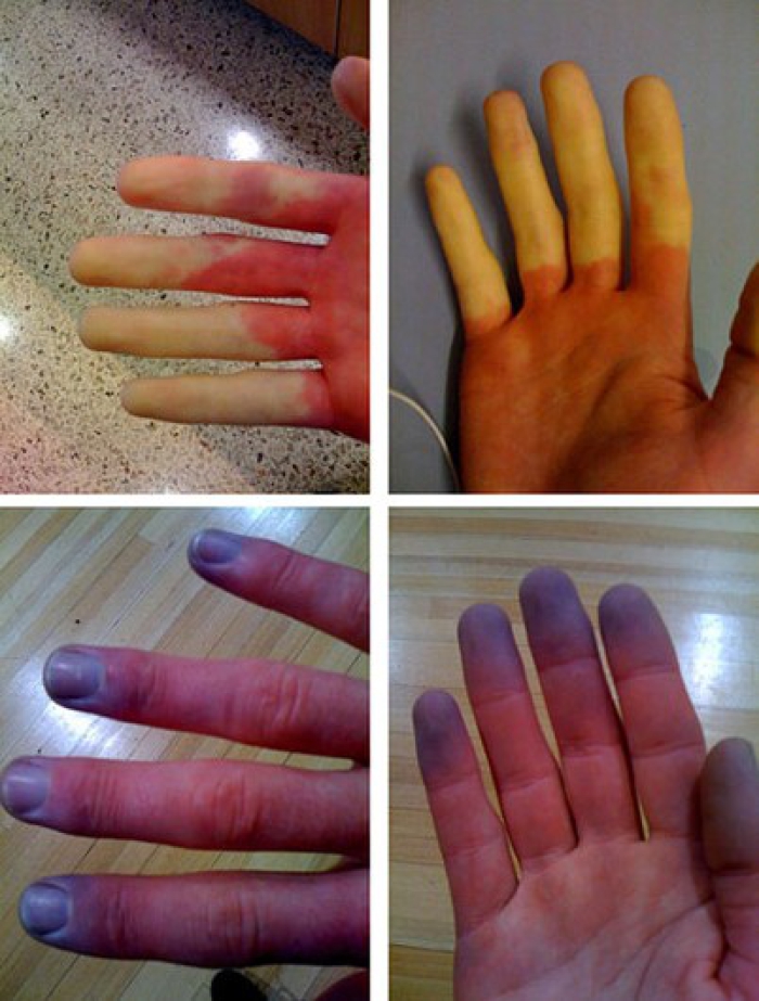 Foto's van verkleuringen aan de vingers tijdens een aanval. 