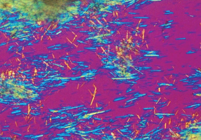 Microscopisch beeld van naaldvormige urinezuurkristallen